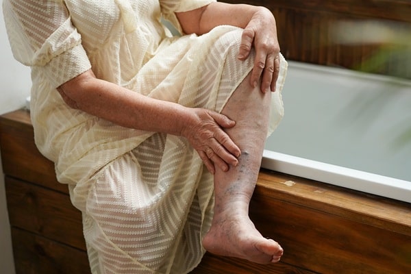 Swollen Legs? It Might Be a Warning Sign