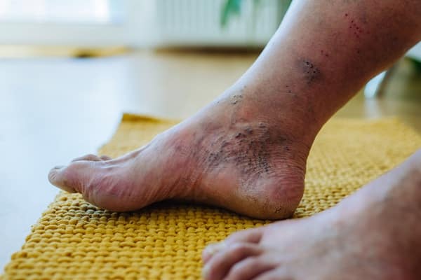 Swollen Legs? It Might Be a Warning Sign